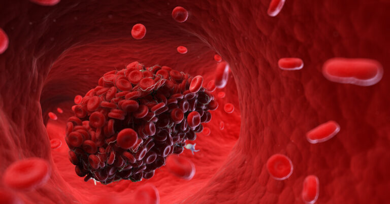Detractores de las vacunas contra el COVID-19 tergiversan un seminario de los CDC sobre las causas de los coágulos sanguíneos